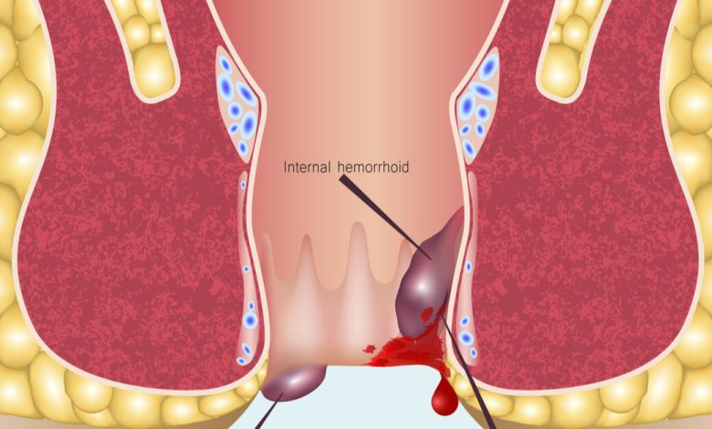 تجاربكم مع البواسير