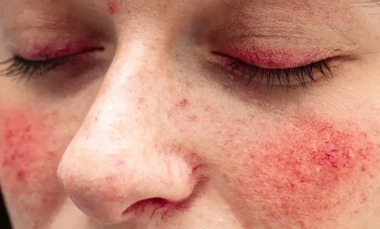 تجاربكم مع الذئبة الحمراء