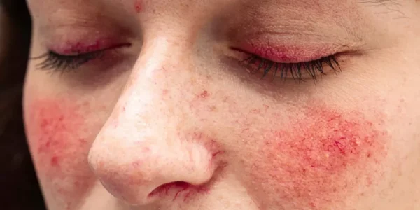 تجاربكم مع الذئبة الحمراء