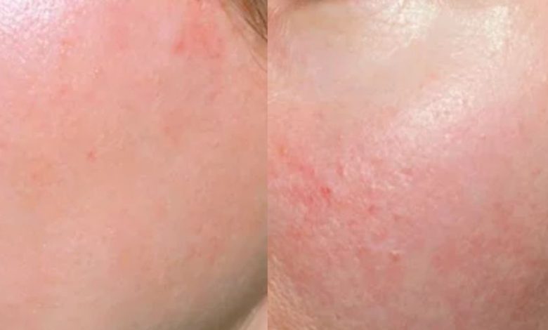 تجربتي مع الديرما بن المنزلي والطريقة الصحيحة لها