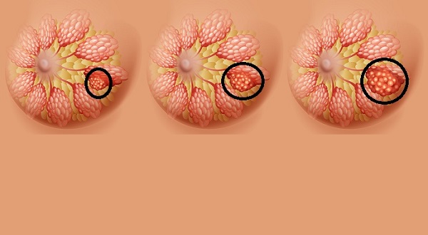 تجربتي مع ترميم الثدي بعد السرطان