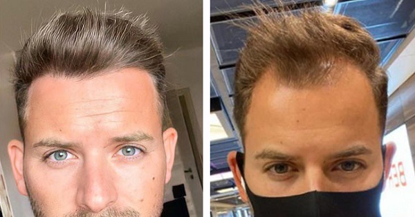 تجربتي مع زراعة الشعر