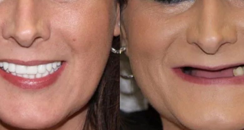 تجربتي مع زراعة عظم الفك