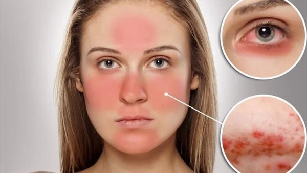 تجربتي مع علاج حساسية الوجه