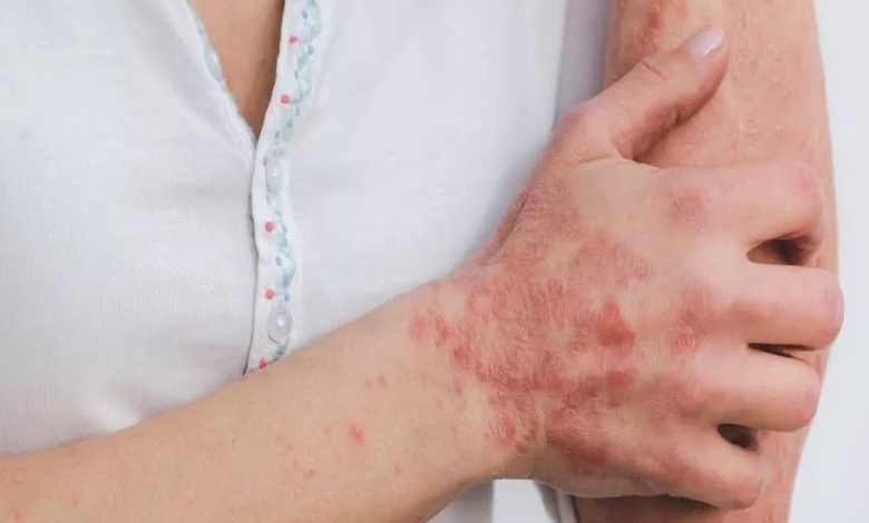 أحدث طرق علاج مرض الصدفية