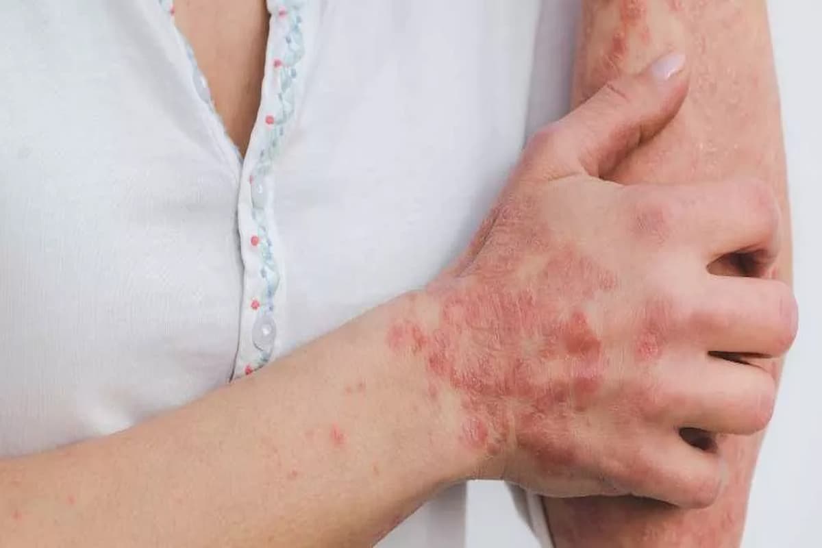 أحدث طرق علاج مرض الصدفية وأسبابها 1 أحدث طرق علاج مرض الصدفية