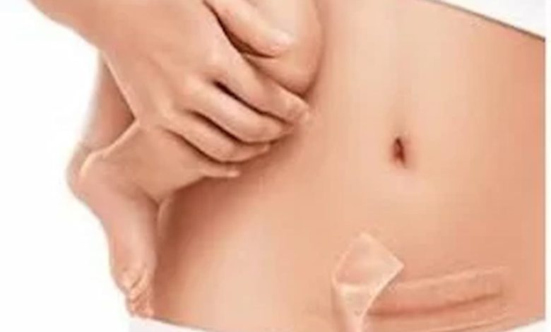 أسباب بروز مكان الخياطة بعد الولادة 0