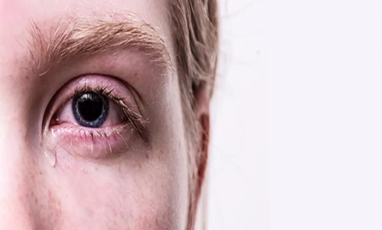 أسباب حرقان العين