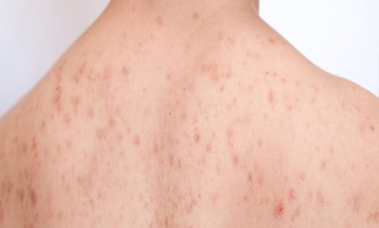 أسباب ظهور حبوب حمراء في الجسم