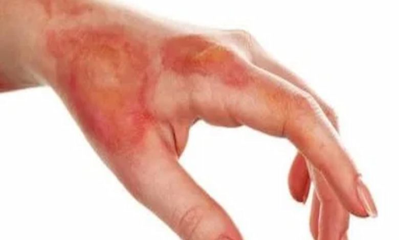 أسرع طريقة لعلاج الحرق في المنزل