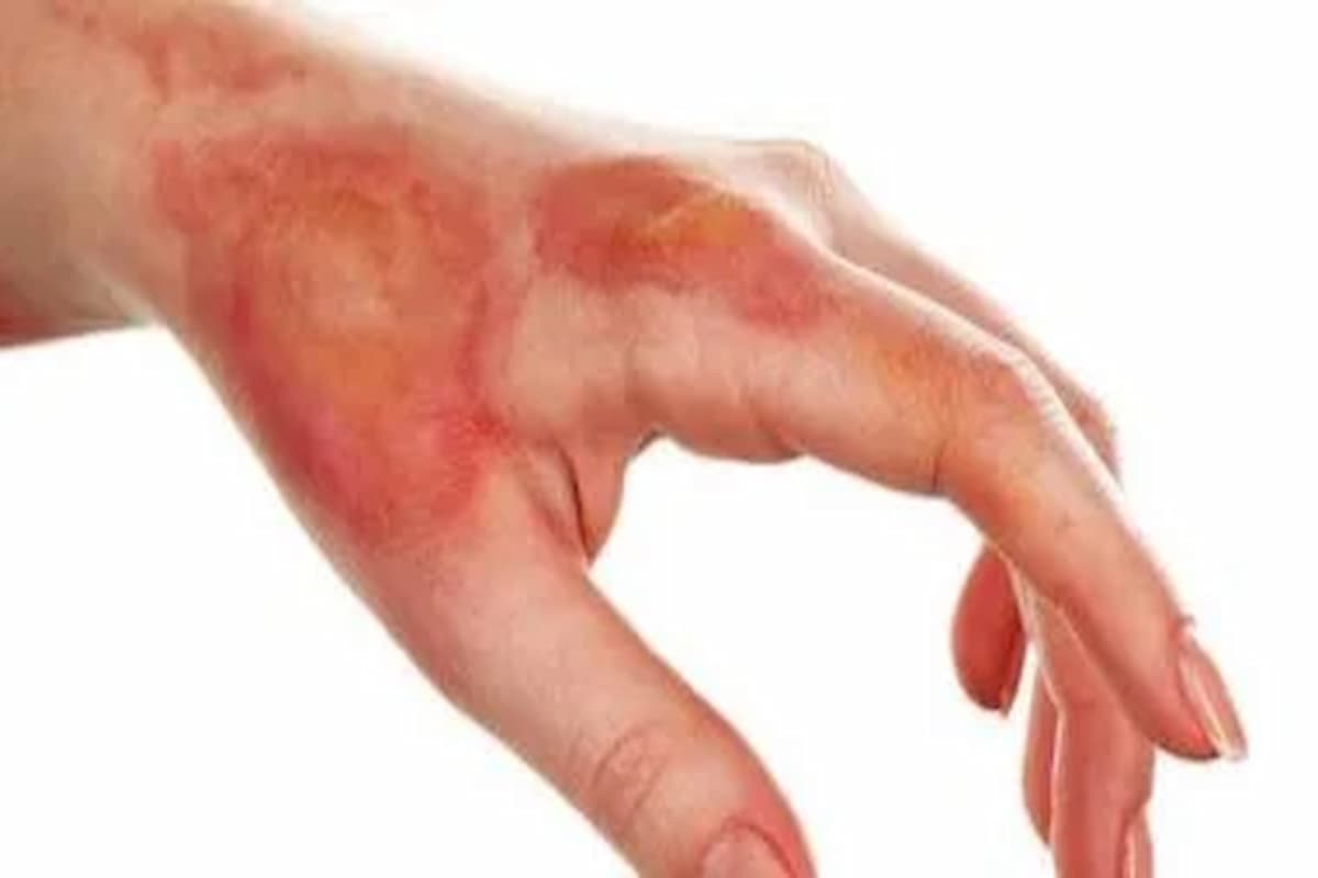 علاج الحرق في المنزل أفضل وأسرع طريقة 1 أسرع طريقة لعلاج الحرق في المنزل