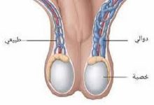 علاج دوالي الخصية طبيعيا 2 علاج دوالي الخصية طبيعيًا