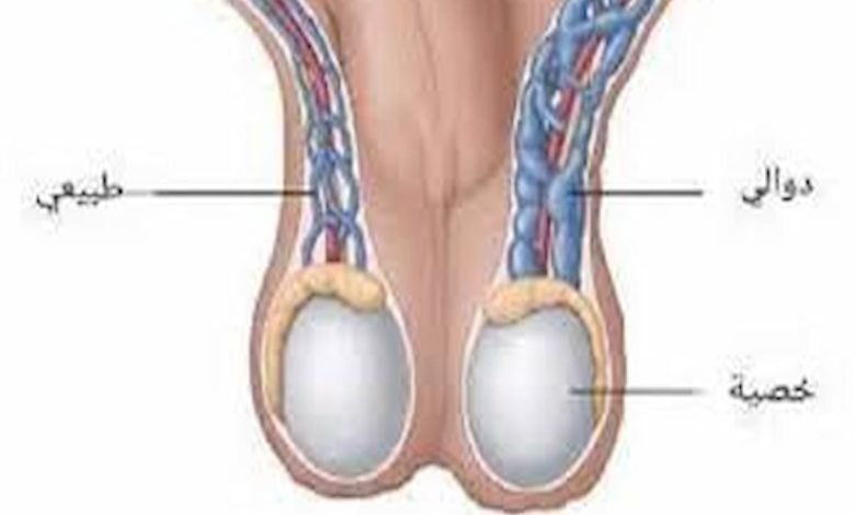 علاج دوالي الخصية طبيعيًا