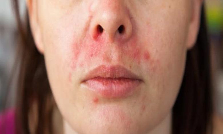 أنواع حساسية الوجه بالصور