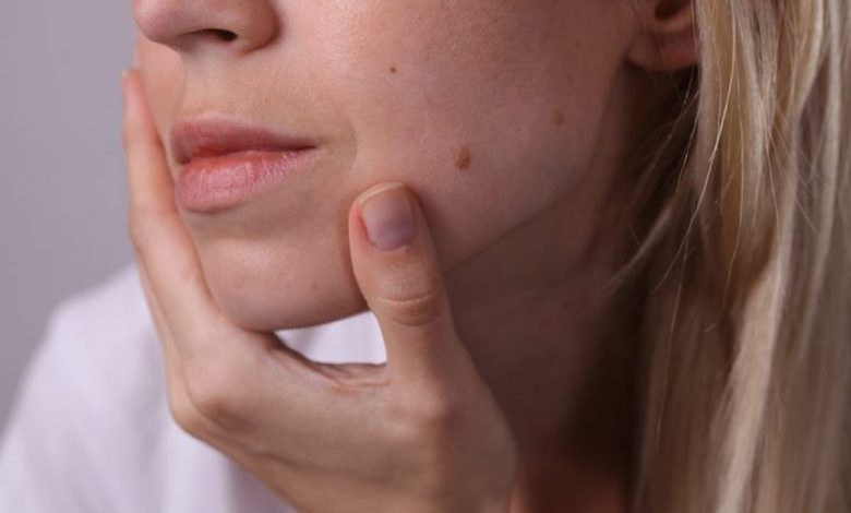 اسباب ظهور الزوائد الجلدية