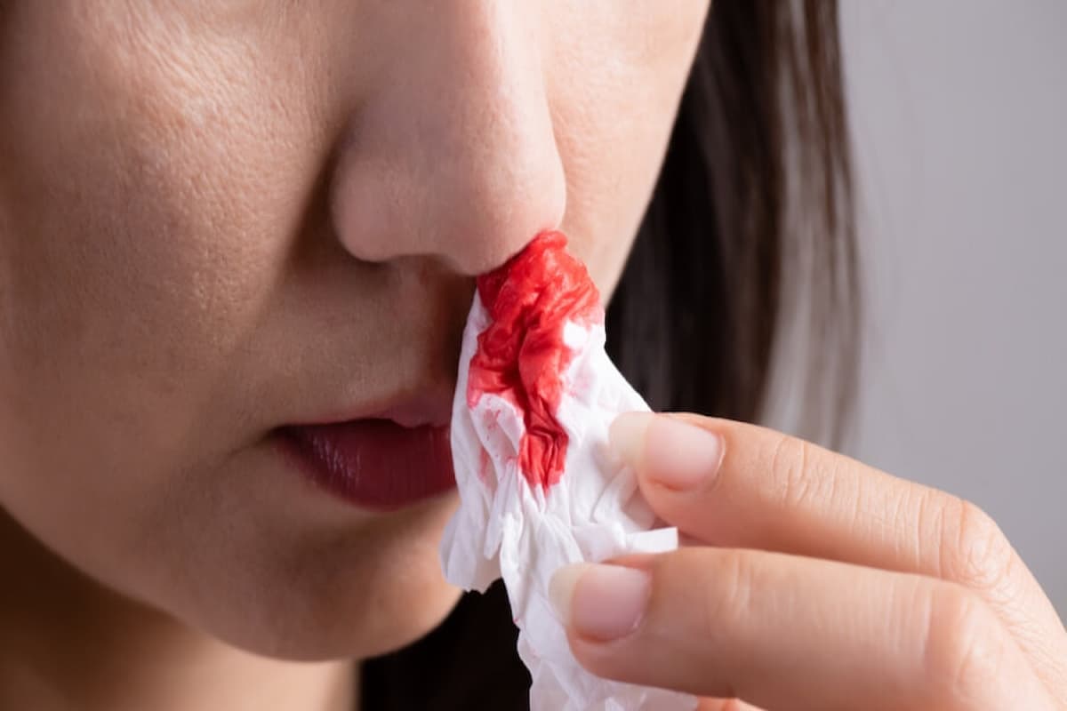 اسباب نزول دم من الانف 1 اسباب نزول دم من الانف