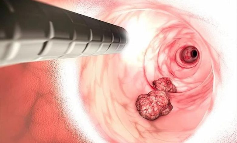اعراض سرطان القولون