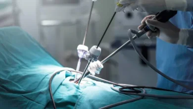 تجربتي في علاج دوالي الخصية