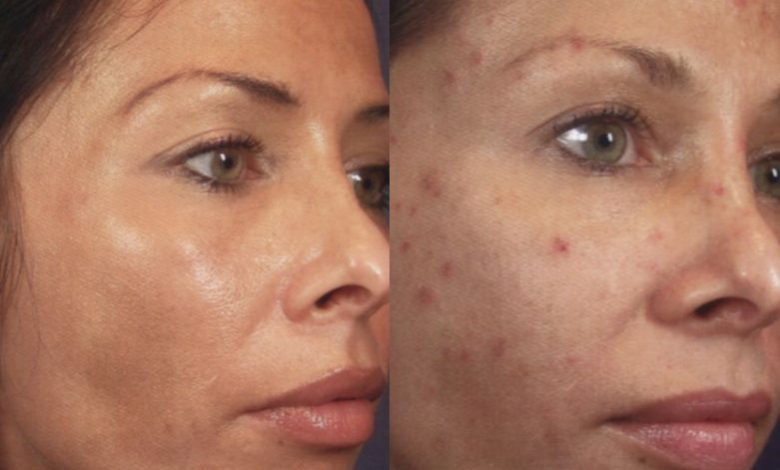 تجربتي مع الديرما بن للتشققات