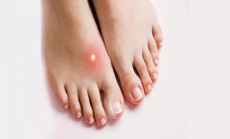 تجربتي مع الفقس في باطن القدم