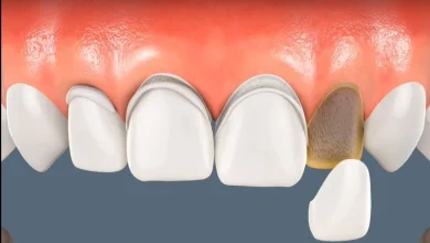 تجربتي مع الفينير المتحرك في تجميل اسناني لتحسين مظهر ابتسامتي