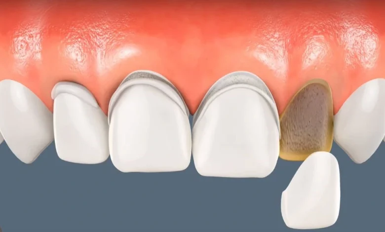 تجربتي مع الفينير المتحرك في تجميل اسناني لتحسين مظهر ابتسامتي