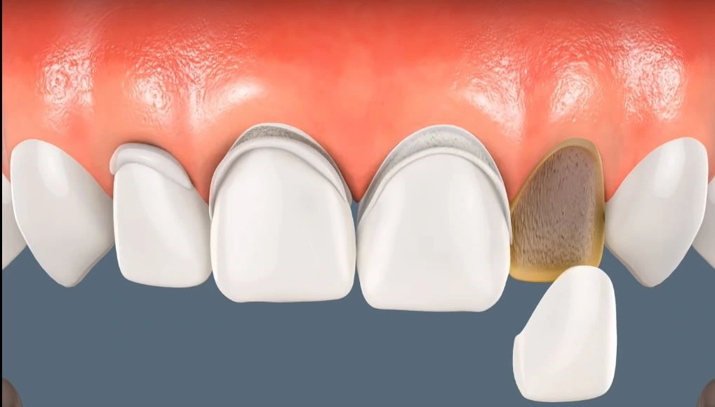 تجربتي مع الفينير المتحرك في تجميل اسناني لتحسين مظهر ابتسامتي