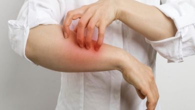 تجربتي مع حبوب الجرب وطريقة التخلص منه نهائيًا