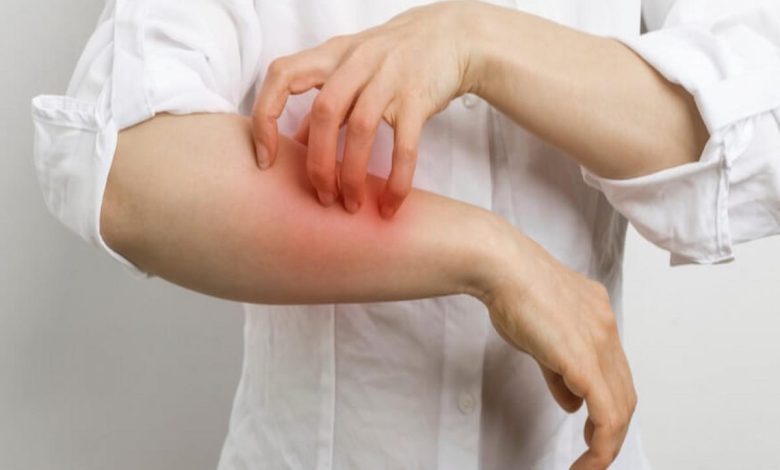 تجربتي مع حبوب الجرب وطريقة التخلص منه نهائيًا