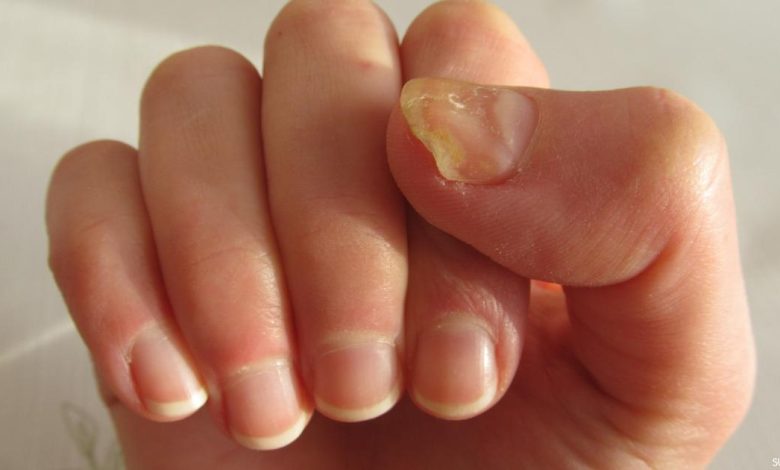 تجربتي مع فطريات الاظافر