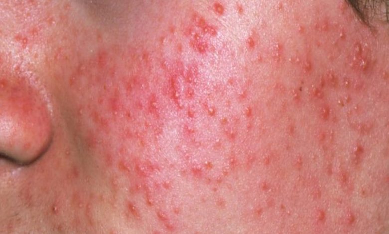 تفسير حلم حبوب حمراء في الوجه