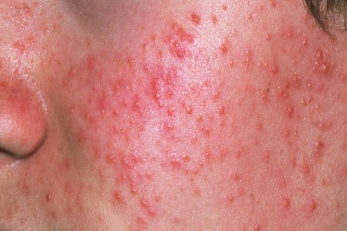 تفسير حلم حبوب حمراء في الوجه