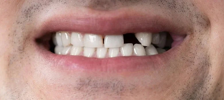 تفسير حلم سقوط الأسنان والإمساك بها