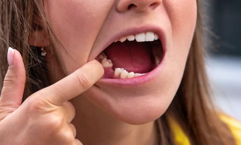 تفسير حلم سقوط الاسنان بدون دم