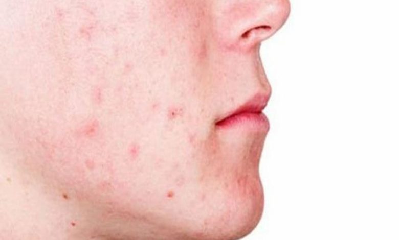 تفسير رؤية حبوب في وجه شخص اعرفه