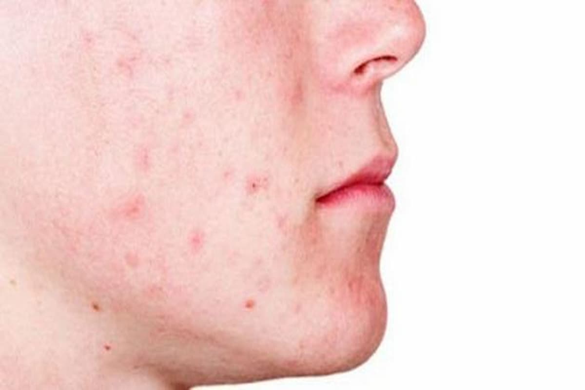 تفسير رؤية حبوب في وجه شخص اعرفه