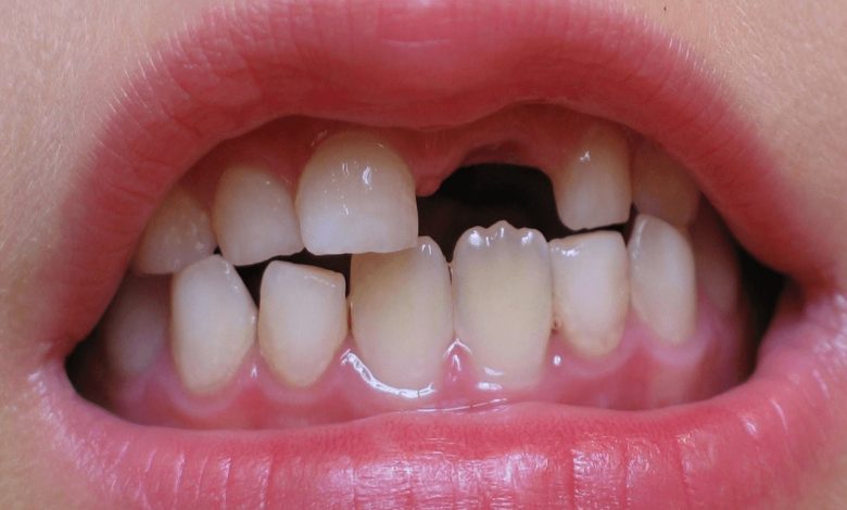 حلمت ان اسناني وقعت ما تفسير الحلم