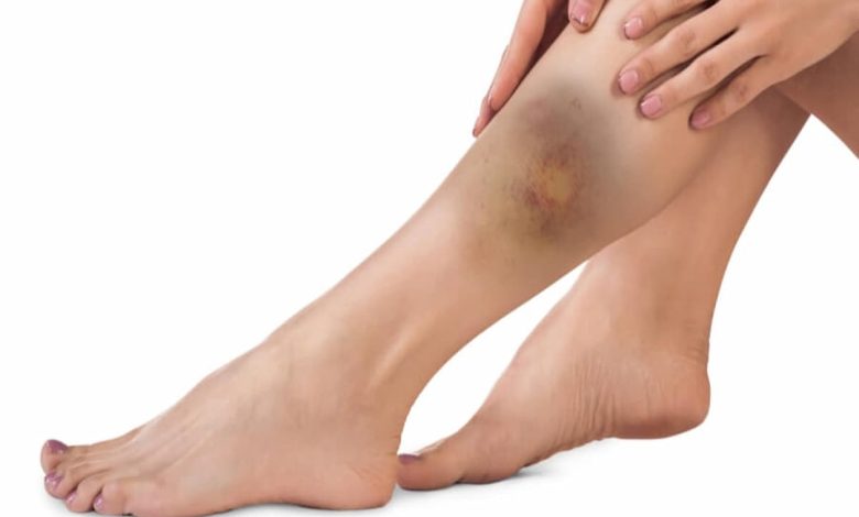 ظهور بقع زرقاء في الجسم عند النساء بدون سبب