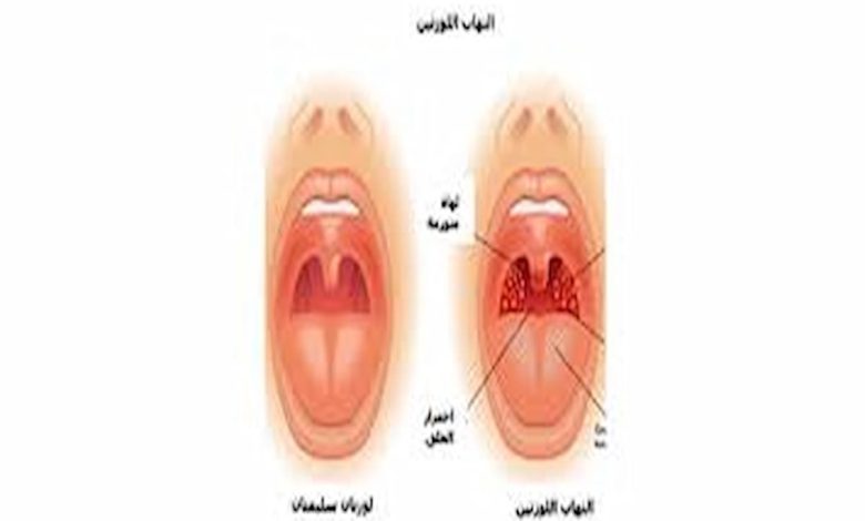 علاج التهاب اللوز في المنزل