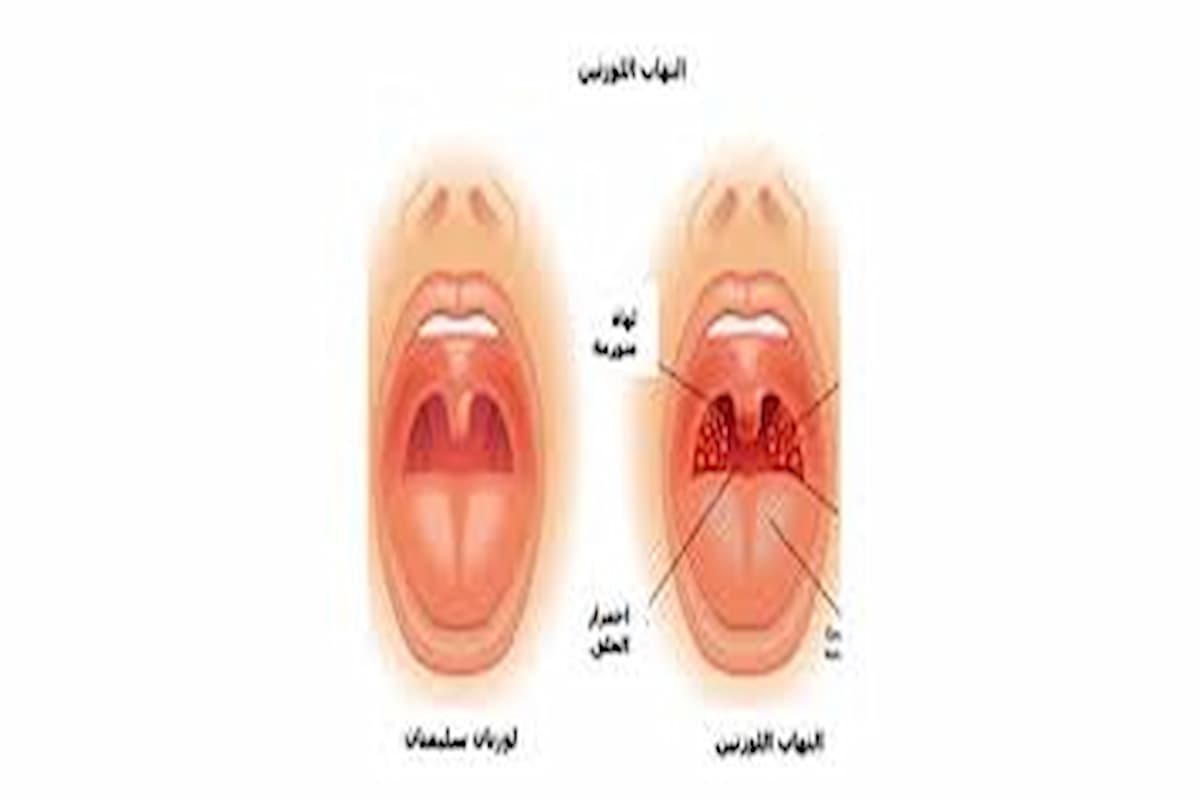 علاج اللوز في البيت 1 علاج التهاب اللوز في المنزل