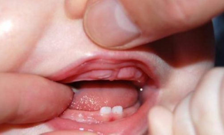 علامات التسنين بالصور