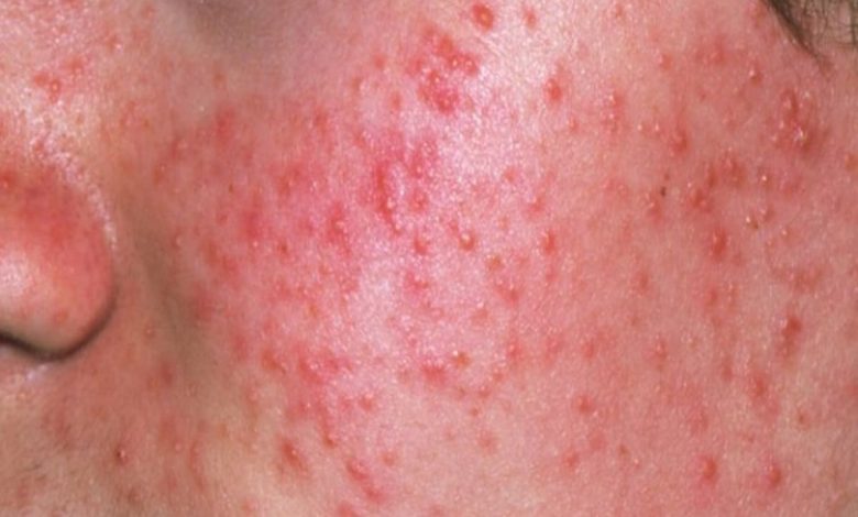 تفسير رؤية حبوب حمراء