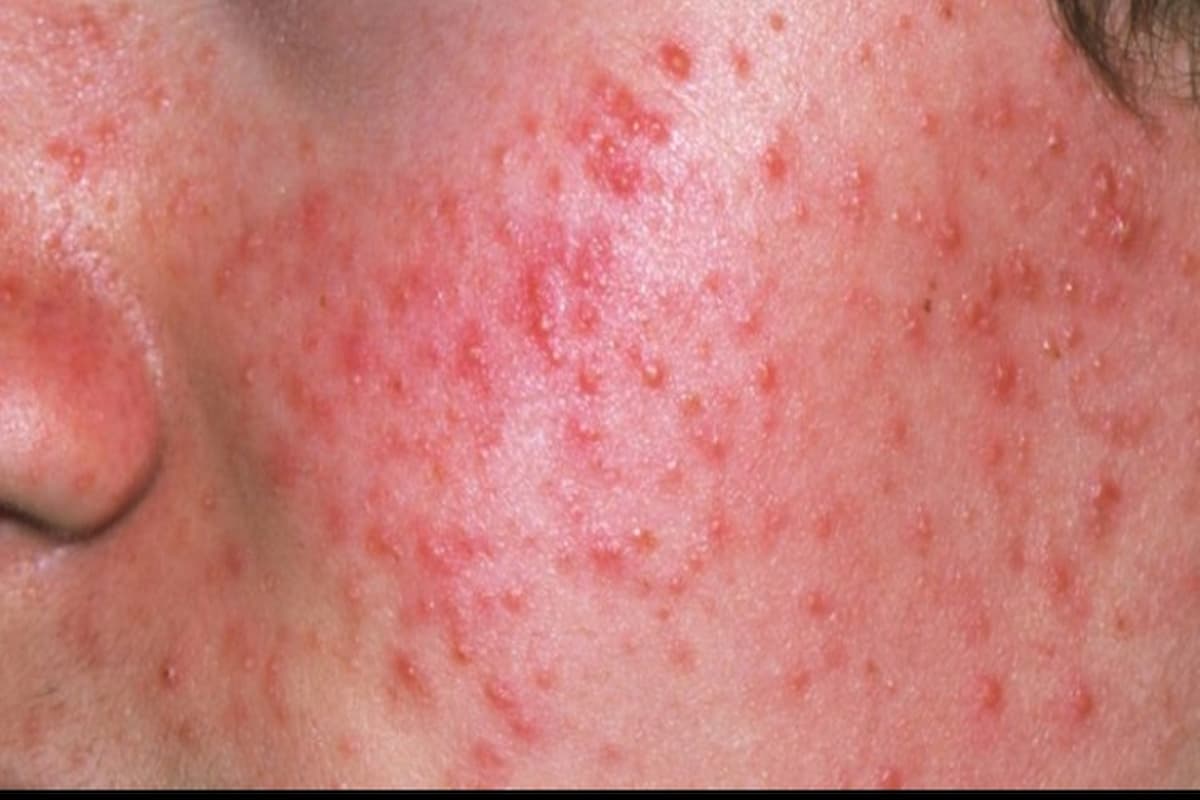 تفسير رؤية حبوب حمراء