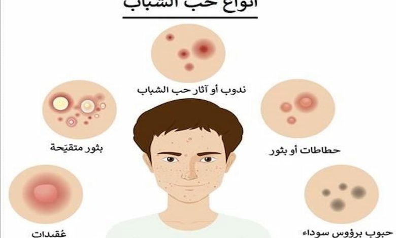 ما هي أنواع حب الشباب