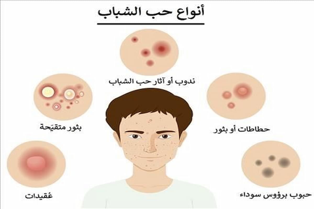 ما هي أنواع حب الشباب وما هي أشكال علاجه 1 ما هي أنواع حب الشباب