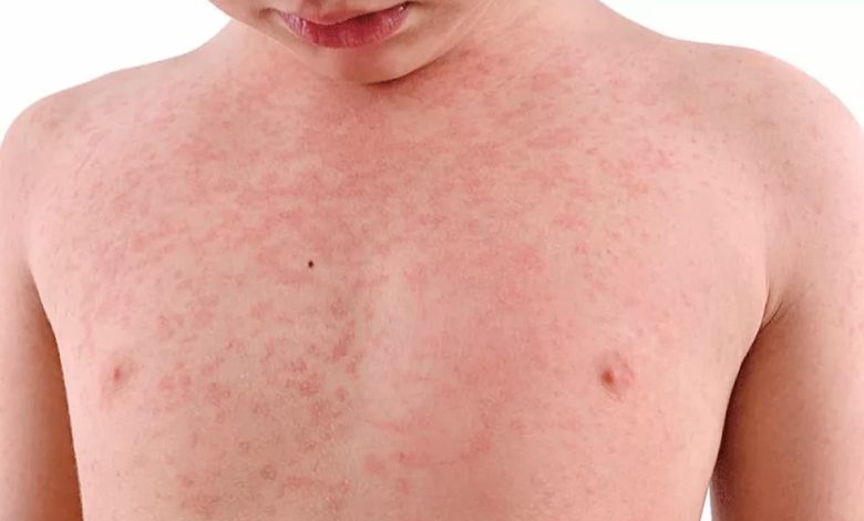 ما هي اعراض الحصبة عند الاطفال