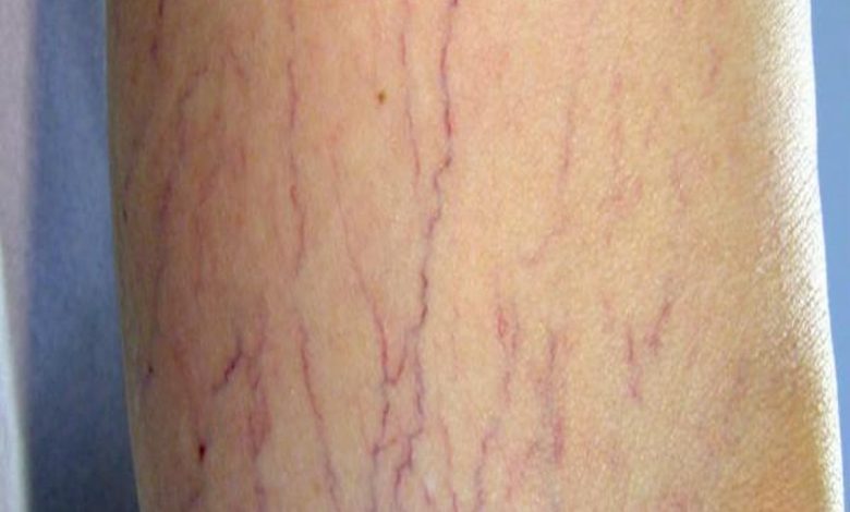 مرض الدوالي بالصور