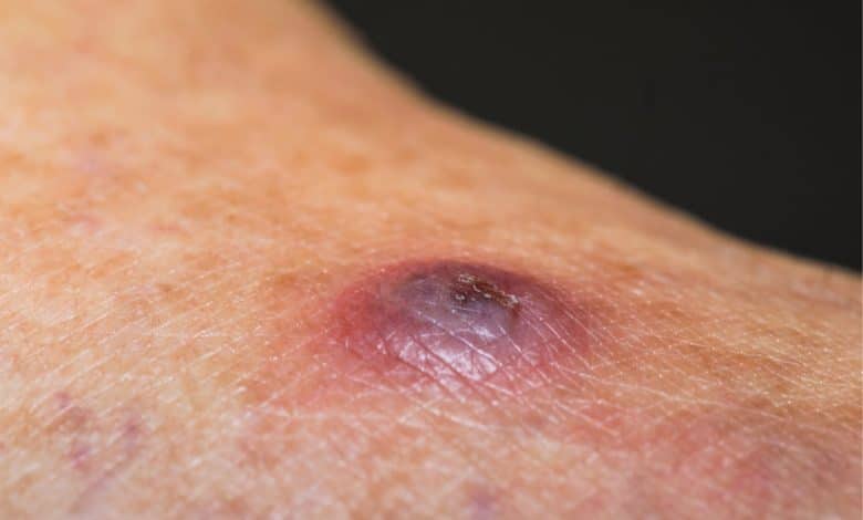 حبة اللشمانيا