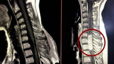 جراحة استئصال ورم معقد داخل الحبل الشوكي بمدينة الملك سلمان الطبية 3 2502841.jpegw800q100fjpg